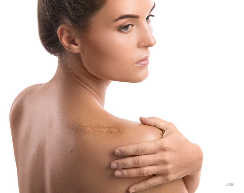 Scar Revision
