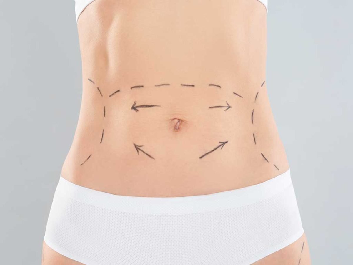 Tummy Tuck